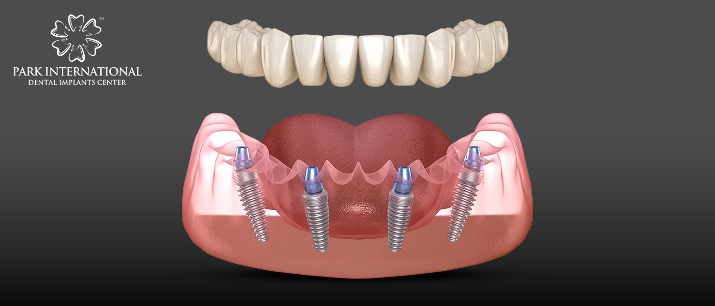 Best Dental Implant Center in Hyderabad, India - Park International Dental Implants Center