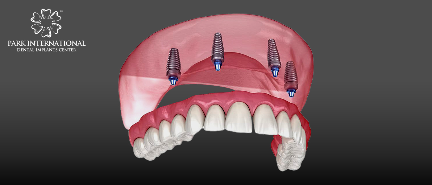 Best Dental Implant Center in Hyderabad, India - Park International Dental Implants Center