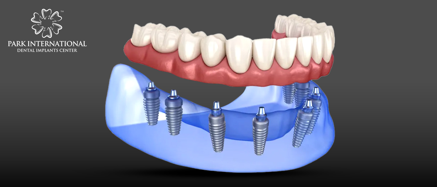 Best Dental Implant Center in Hyderabad, India - Park International Dental Implants Center