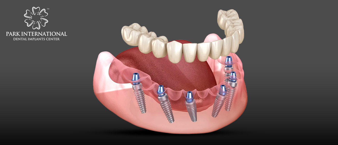 Best Dental Implant Center in Hyderabad, India - Park International Dental Implants Center