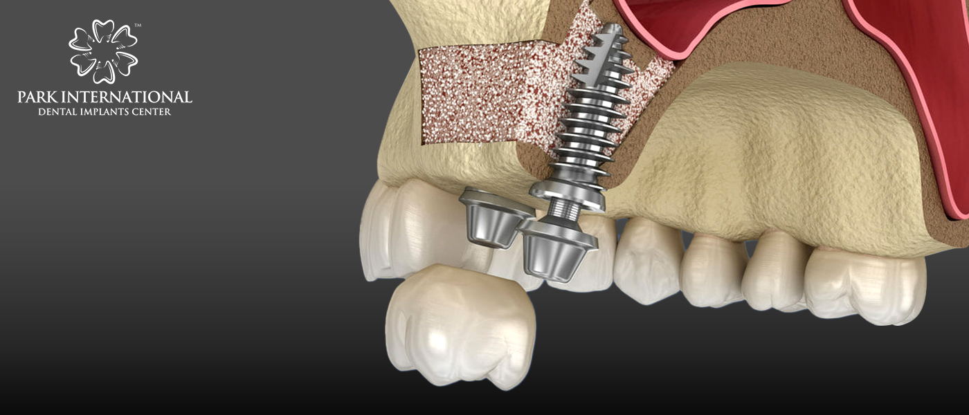 Best Dental Implant Center in Hyderabad, India - Park International Dental Implants Center