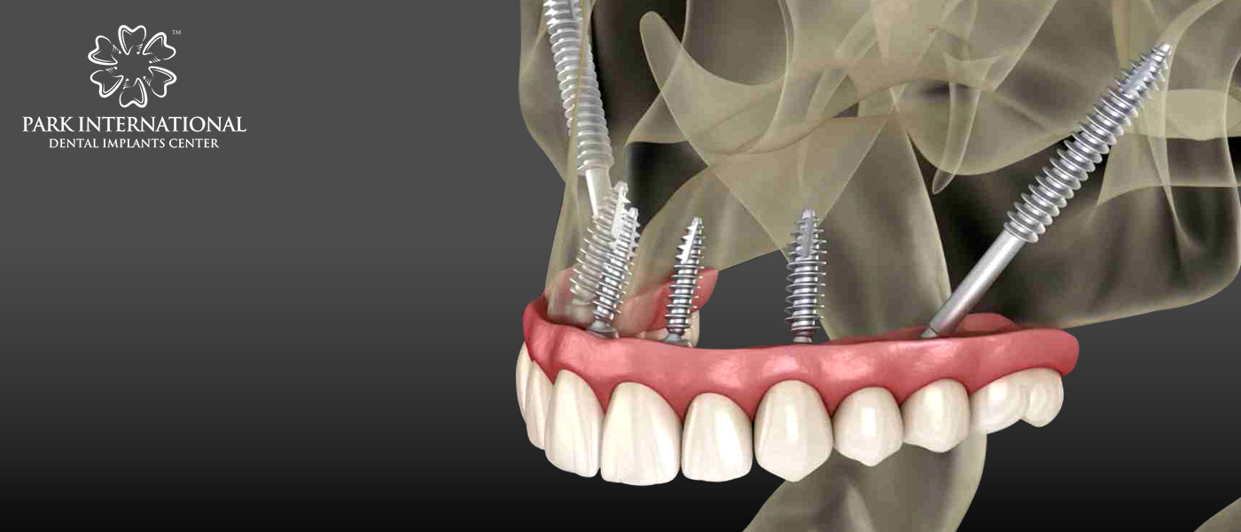Best Dental Implant Center in Hyderabad, India - Park International Dental Implants Center