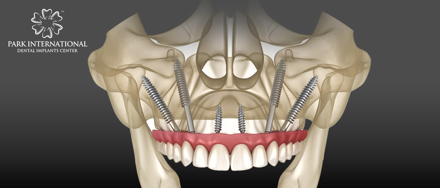 Best Dental Implant Center in Hyderabad, India - Park International Dental Implants Center