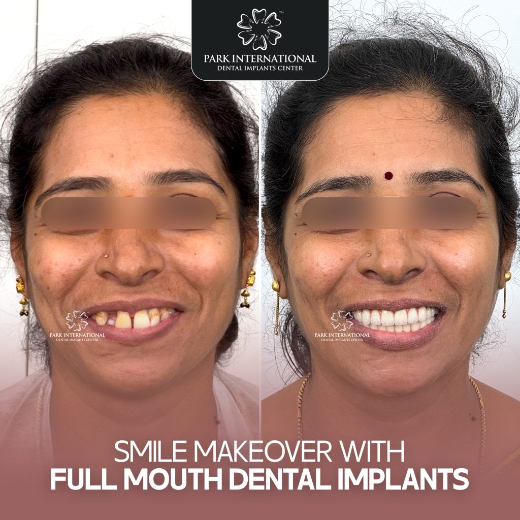 Full Mouth Dental Implants in Hyderabad