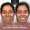  Full Mouth Dental Implants in Hyderabad