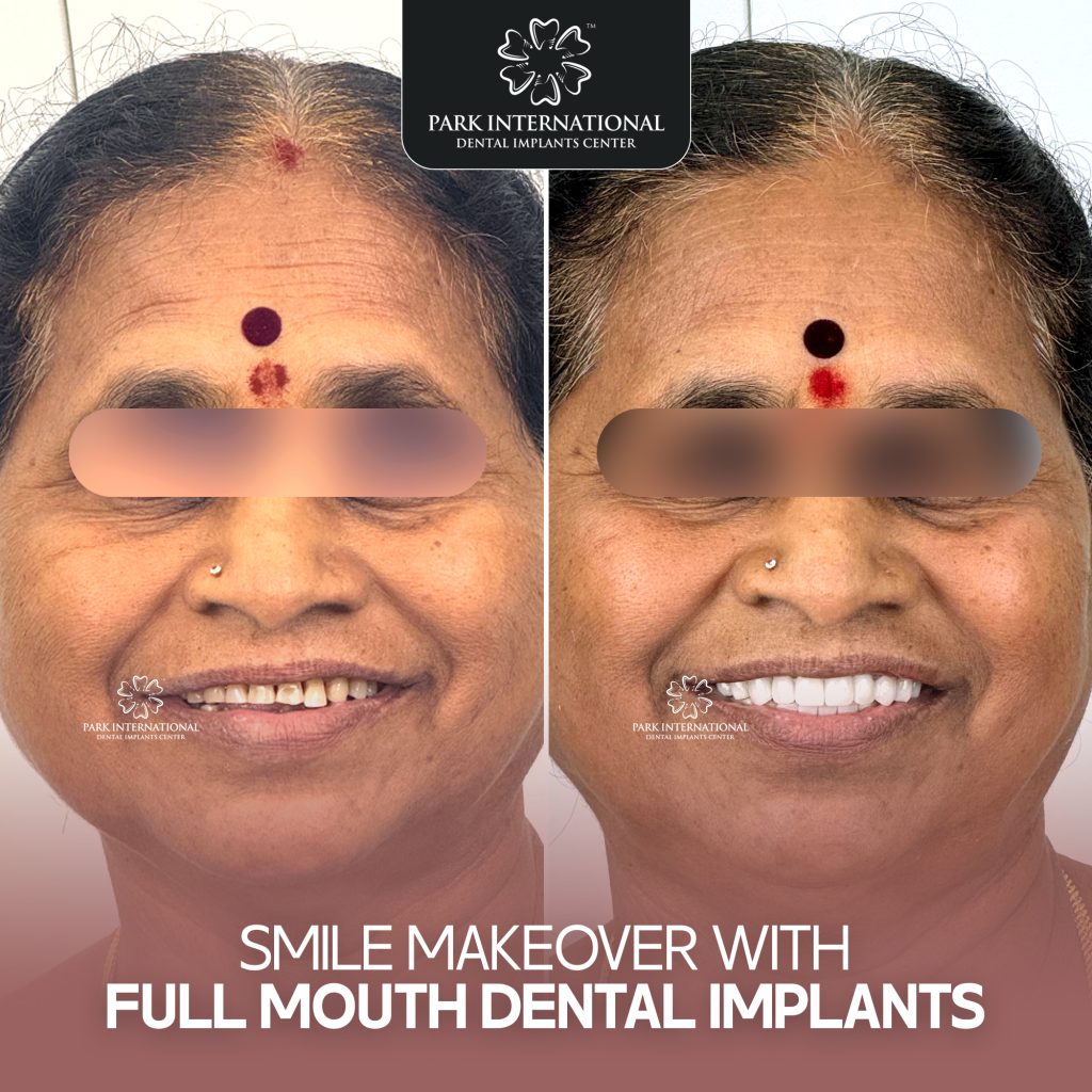 Full Mouth Dental Implants in Hyderabad