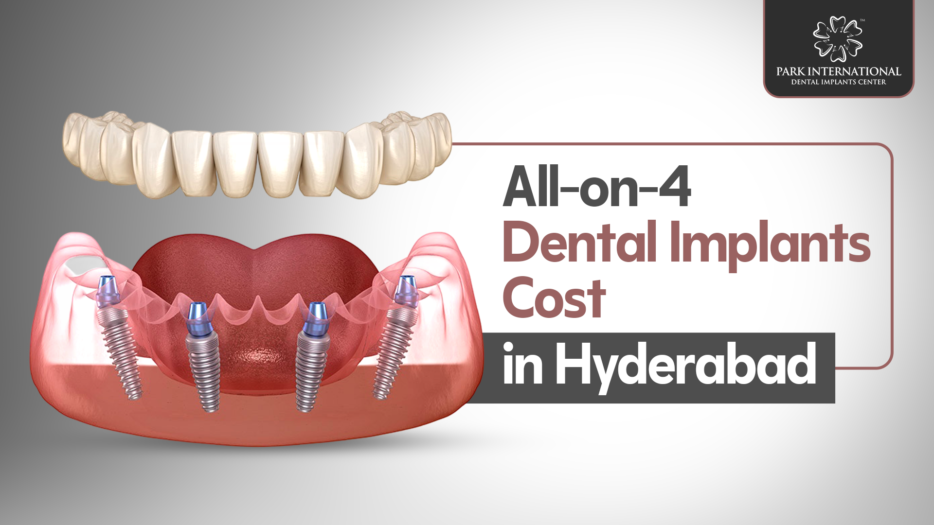 Cost Of All-on-4 Dental Implants in Hyderabad
