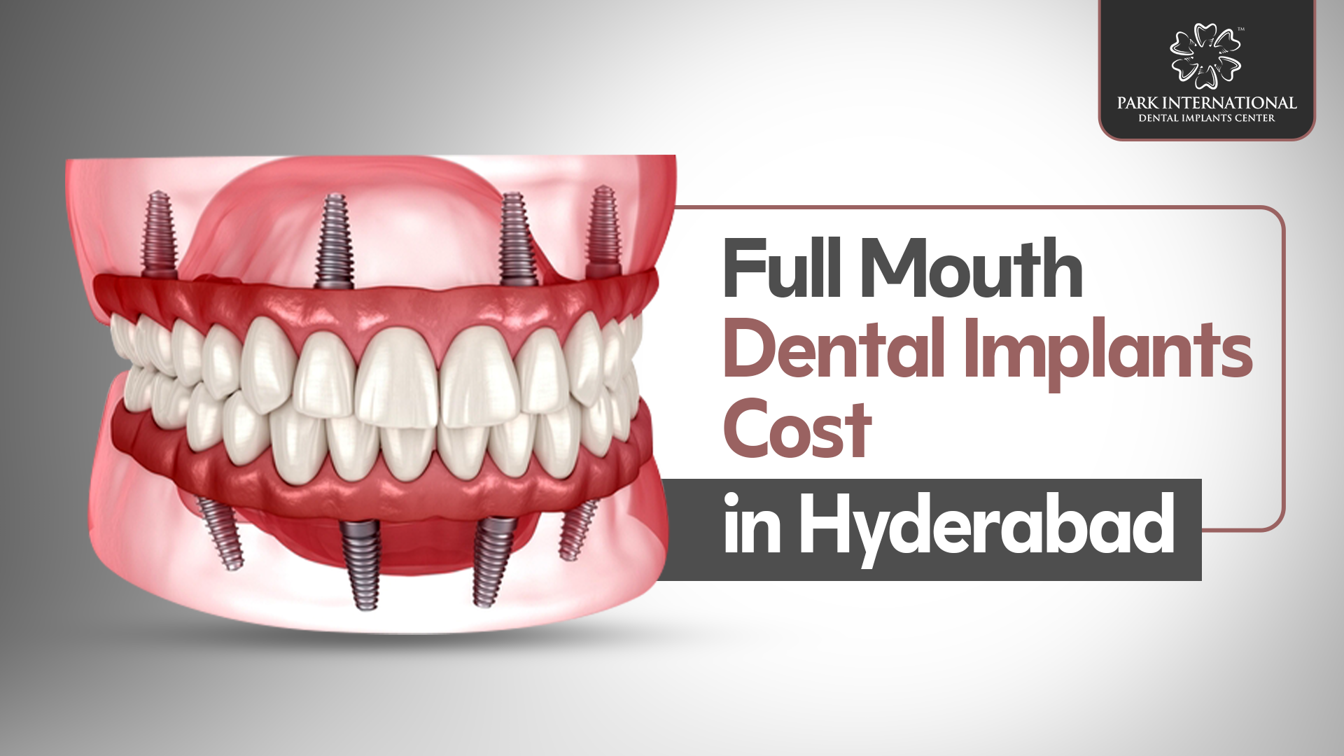 Full Mouth Dental Implants Cost in Hyderabad