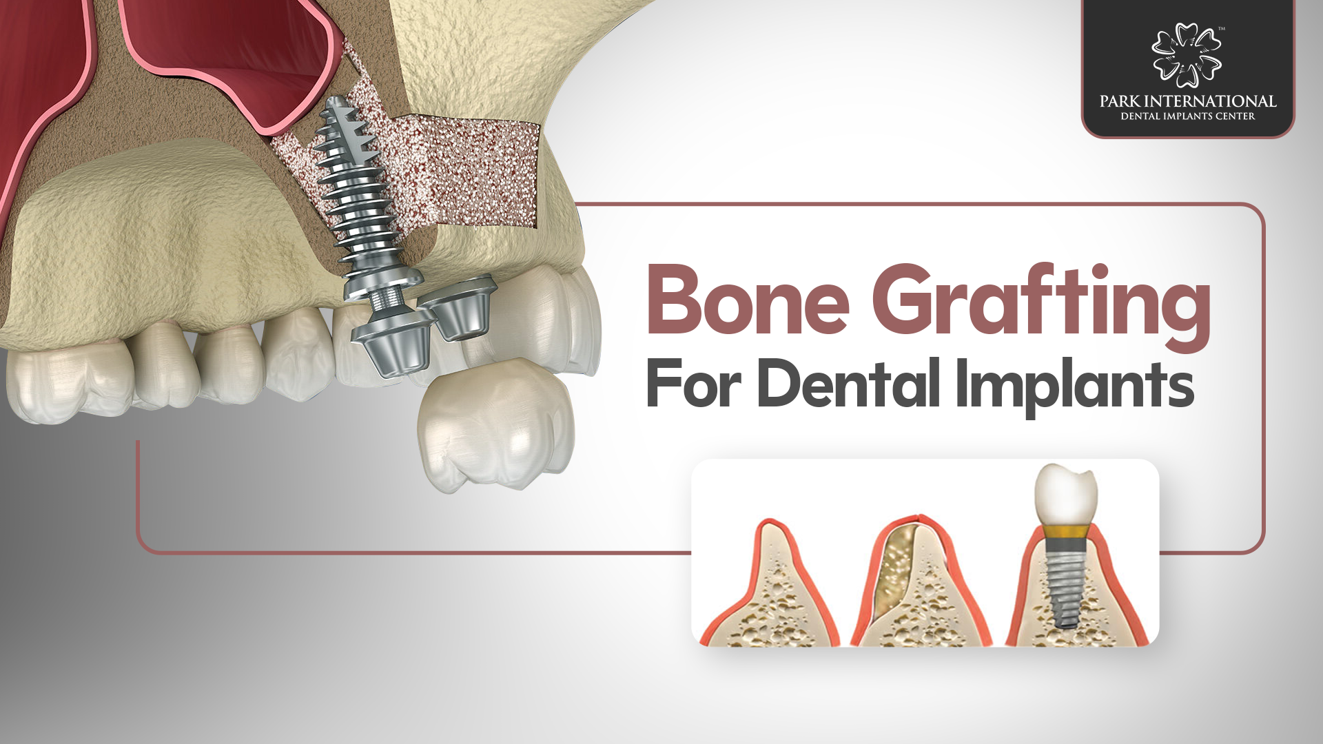 Bone Grafting for Dental Implants in Hyderabad