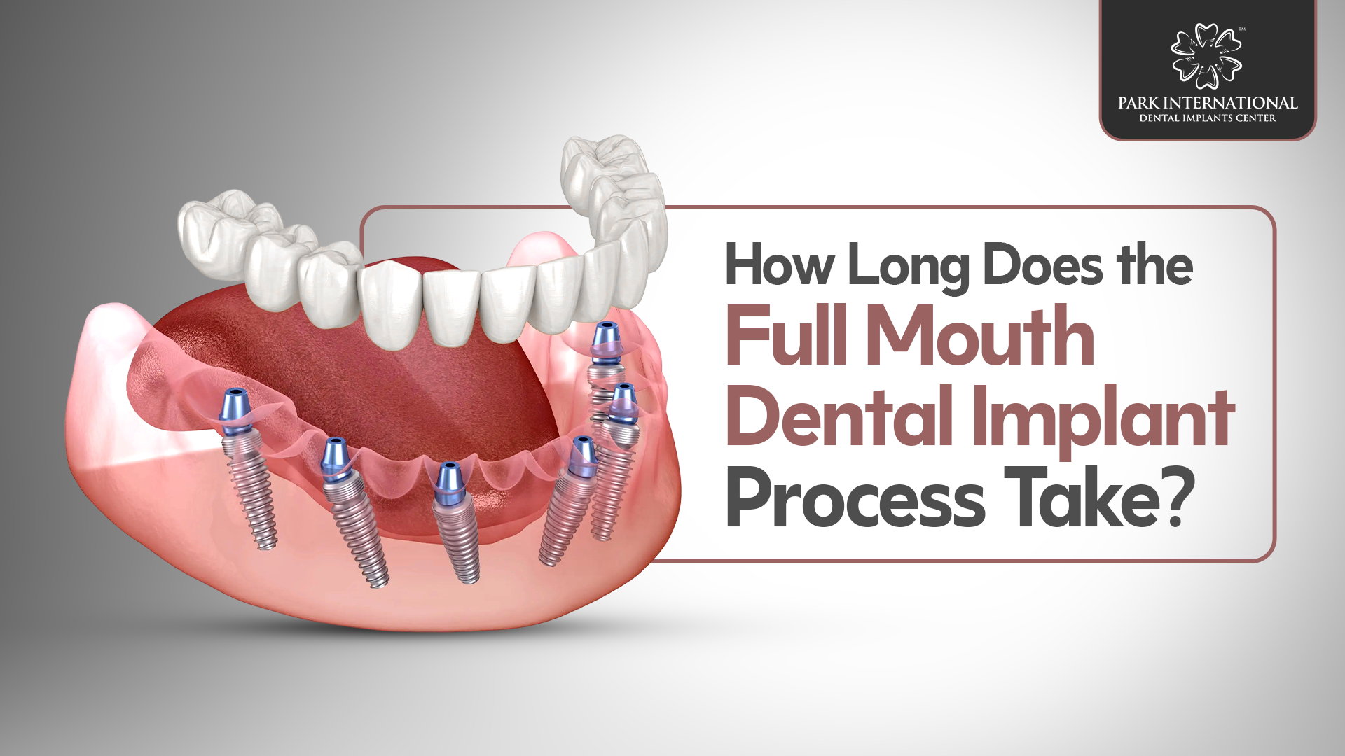 Full Mouth Dental Implants in Hyderabad