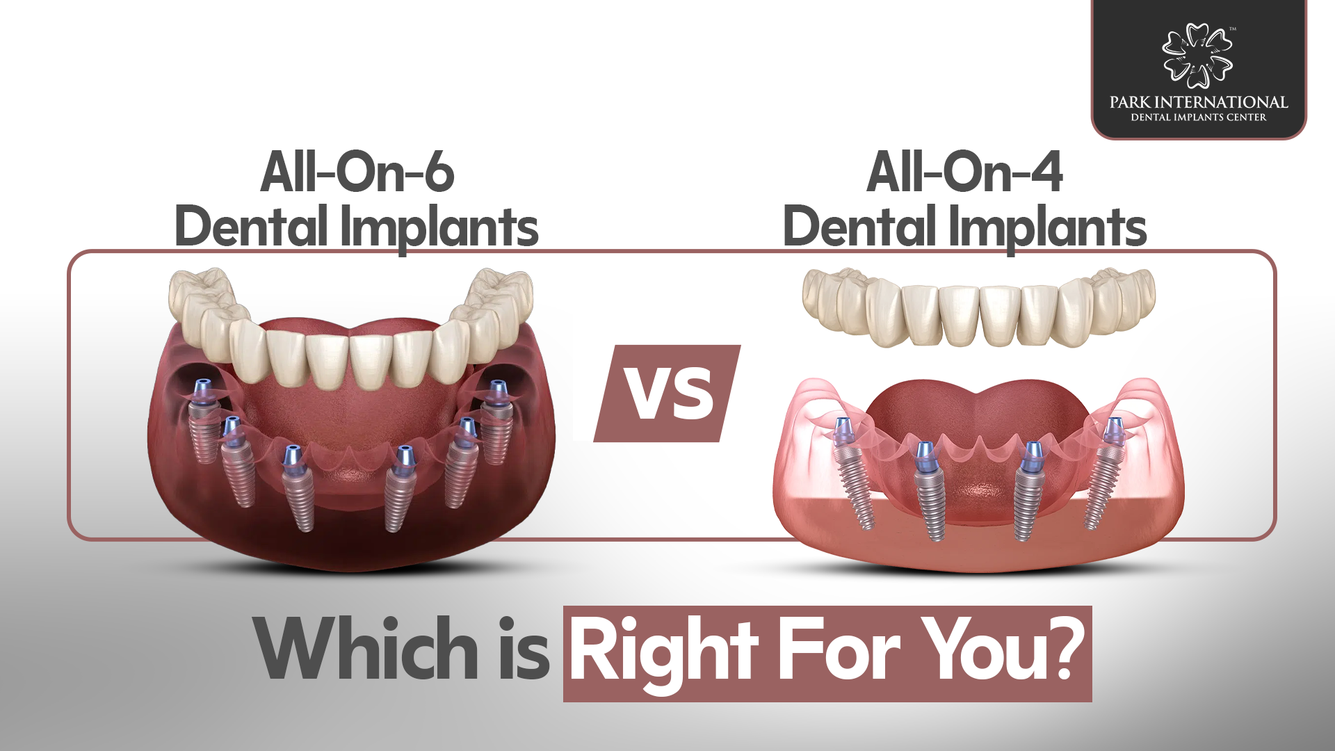 All On 4 Vs All On 6 Dental Implants in Hyderabad