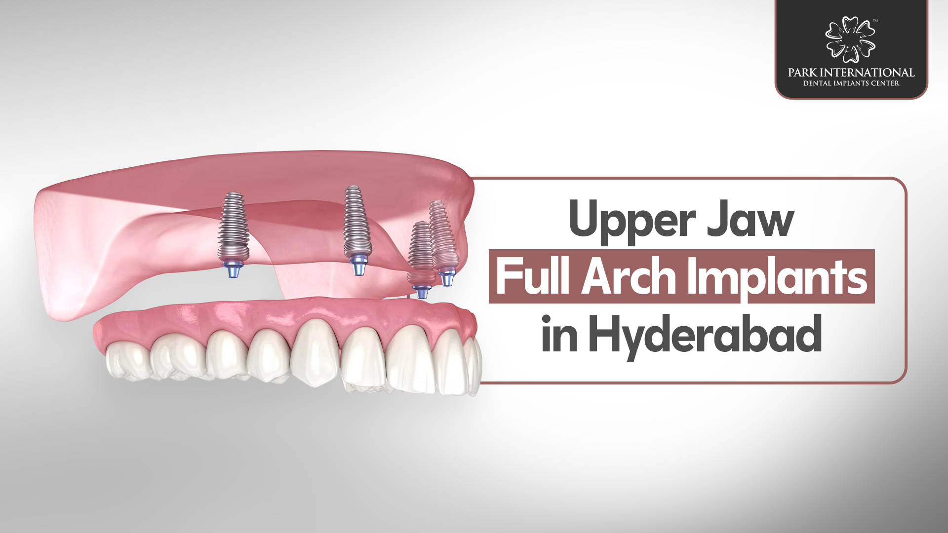 Upper Jaw Full Arch Implants in Hyderabad