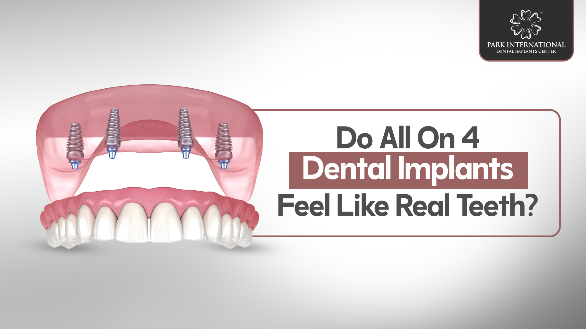 All-on-4 dental implants in Hyderabad