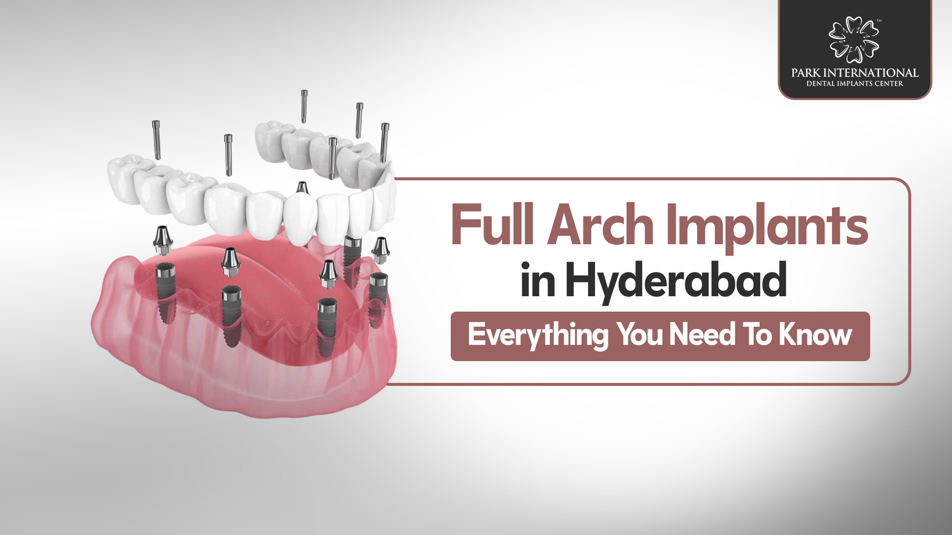 full arch dental implants in Hyderabad