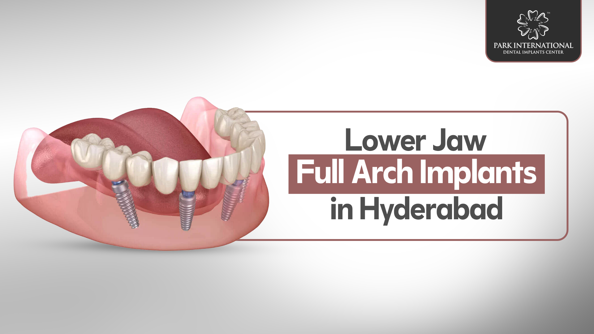 Lower Jaw Full Arch Implants in Hyderabad