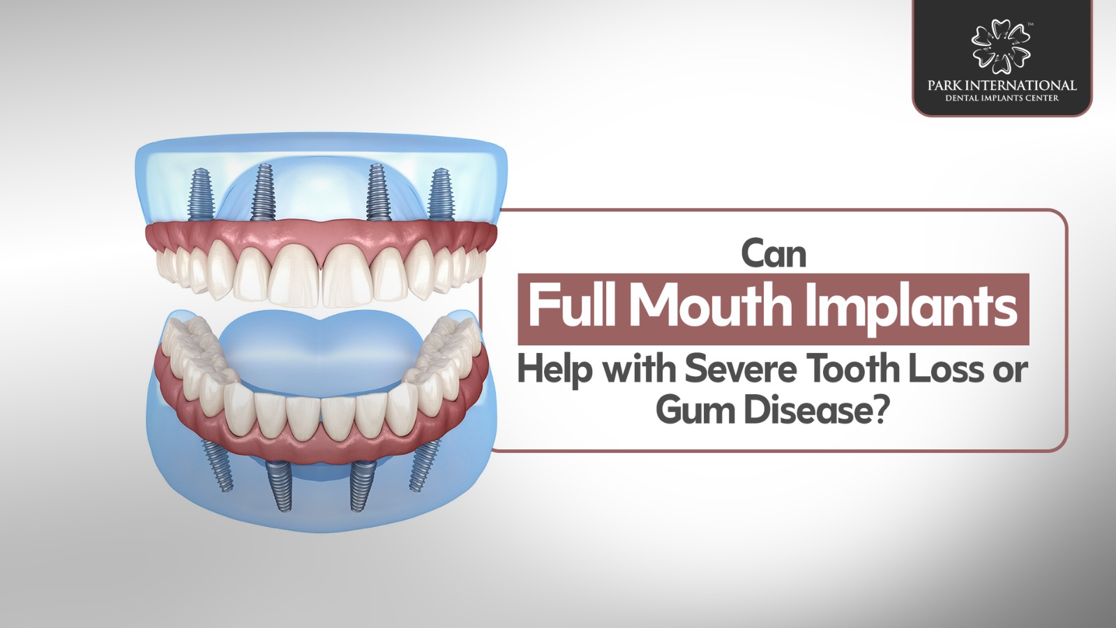 full mouth implants in Hyderabad