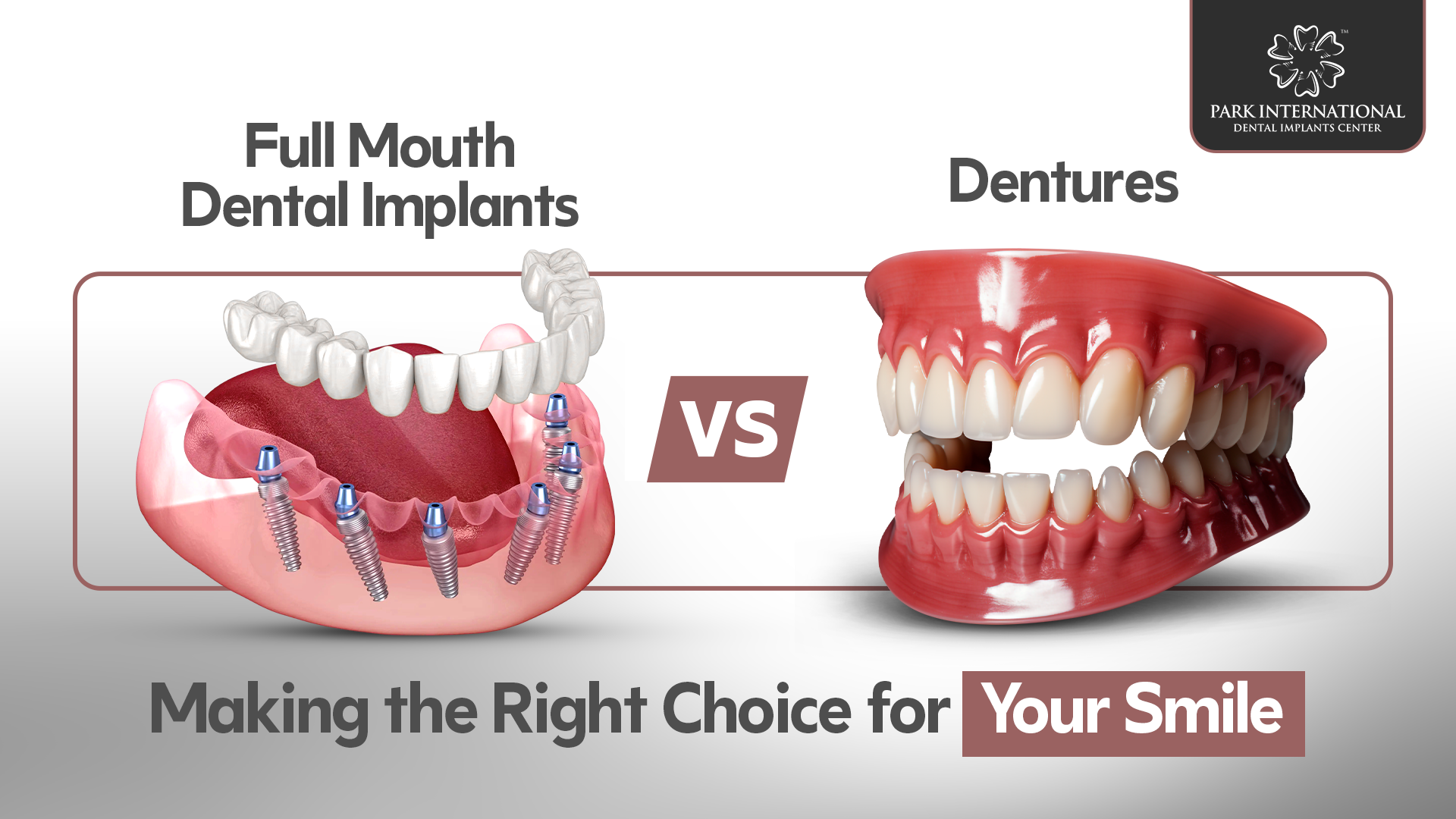 Full Mouth Dental Implants vs. Dentures: