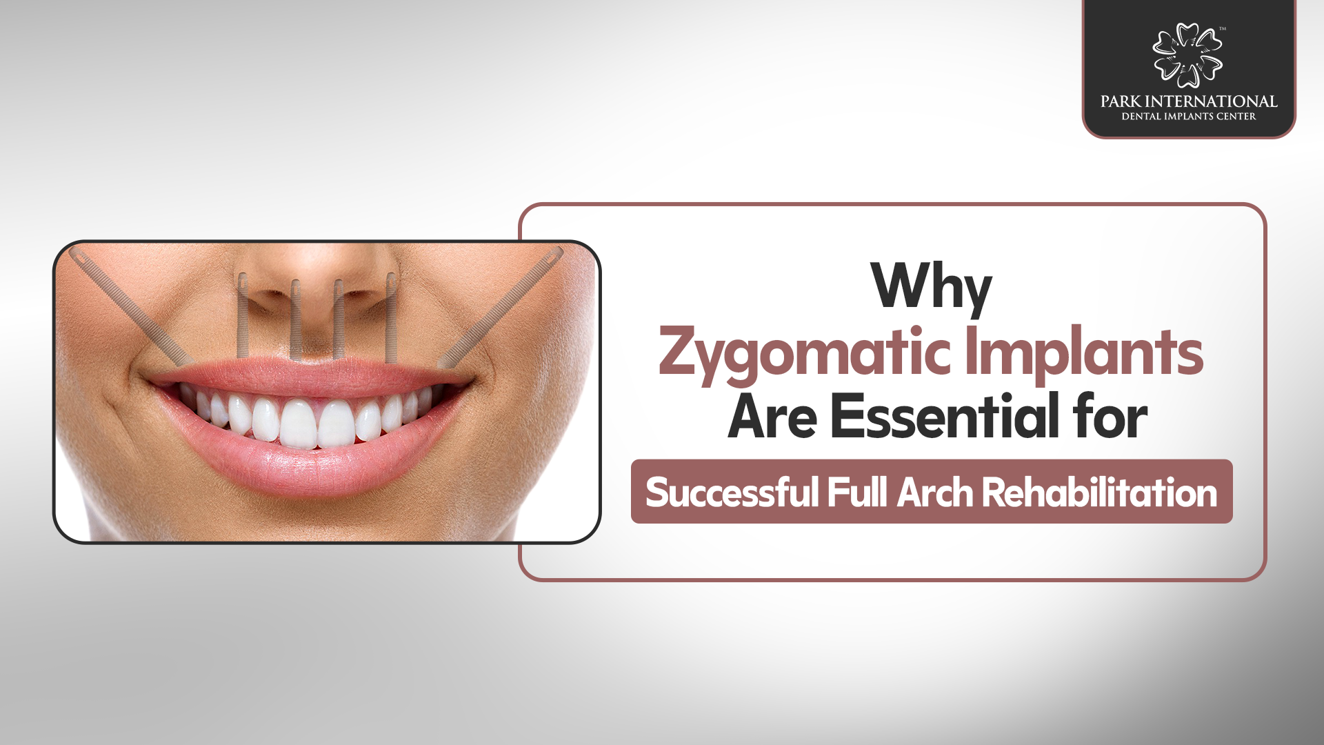 zygomatic implants in Hyderabad