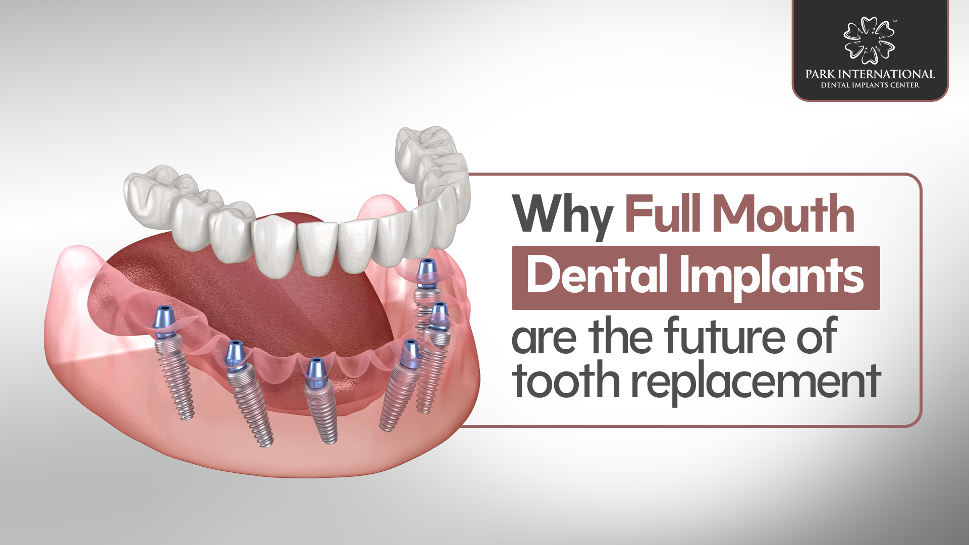 full mouth dental implants in Hyderabad