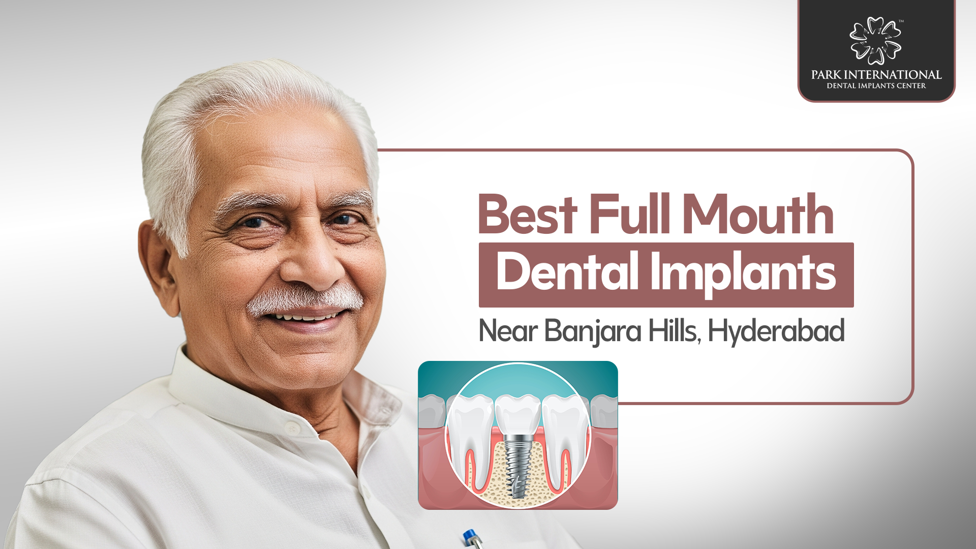 Best Full Mouth Dental Implants Near Banjara Hills