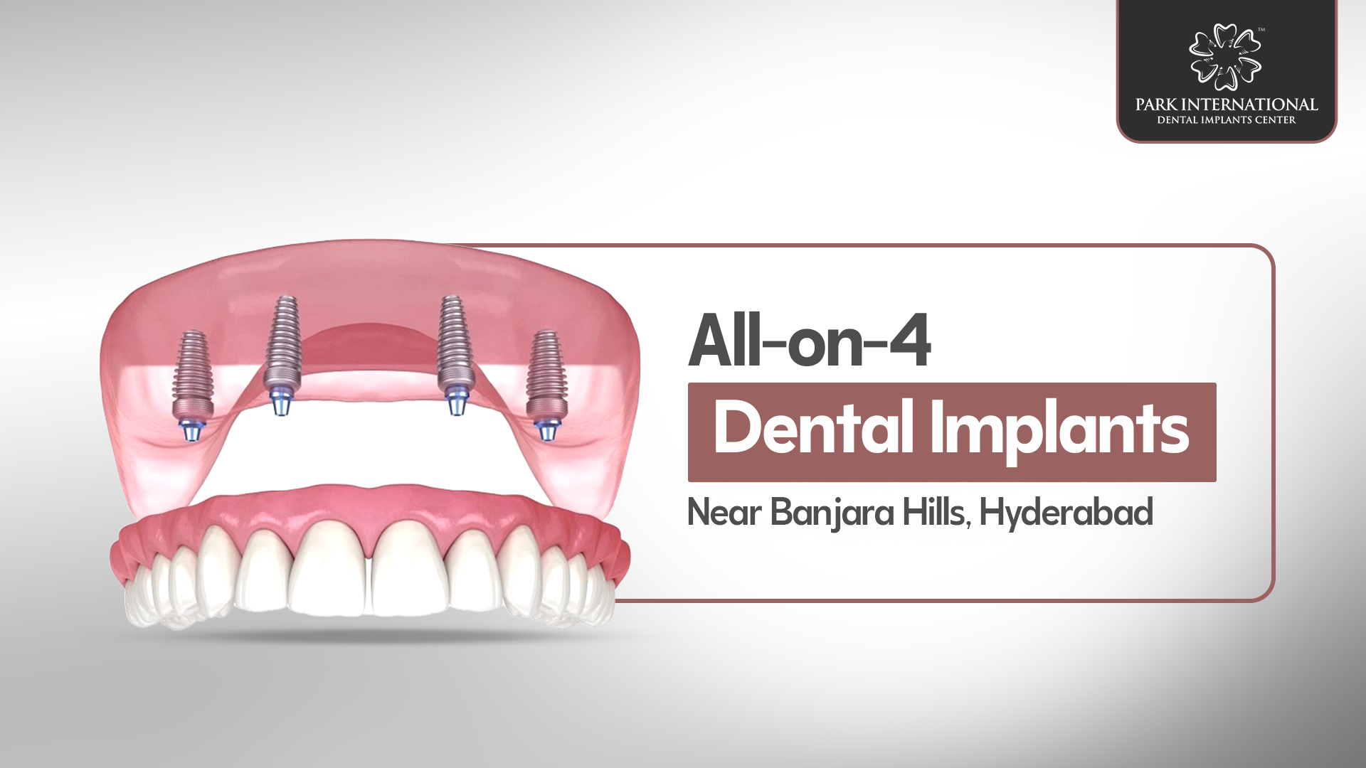 All-on-4-Dental-Implants-Near-Banjara-Hills