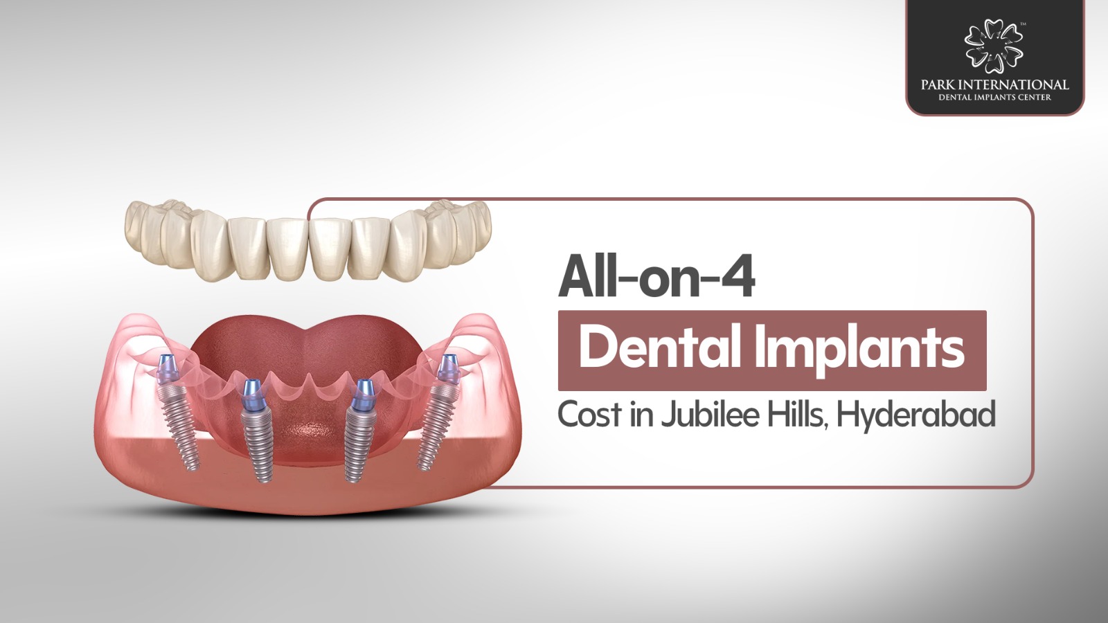All-on-4 Dental Implants Cost in Jubilee Hills