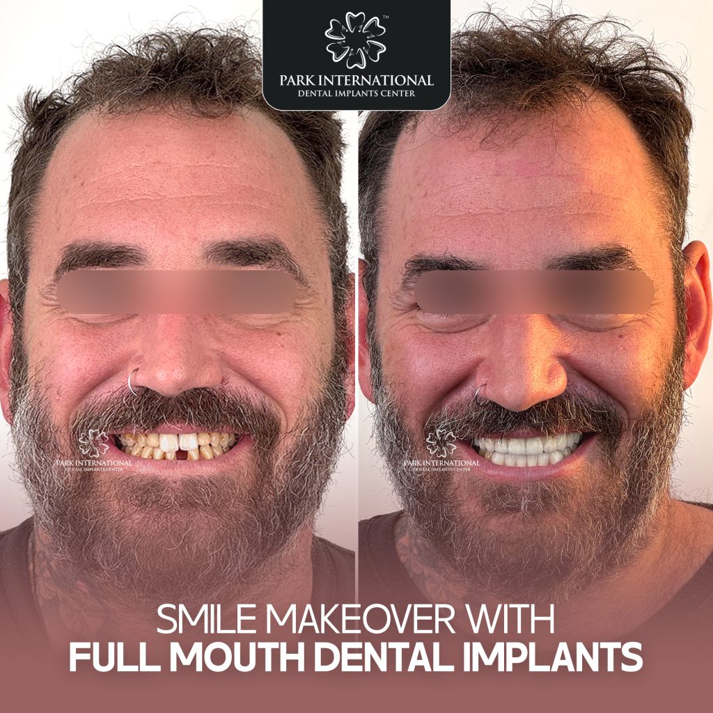 Full Mouth Dental Implants Near Madhapur