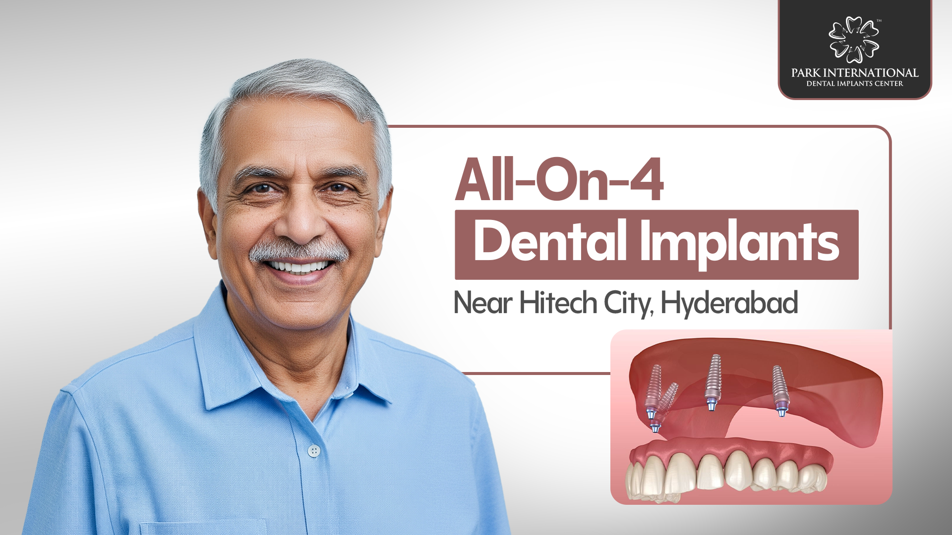 All-On-4 Dental Implants Near Hitech City