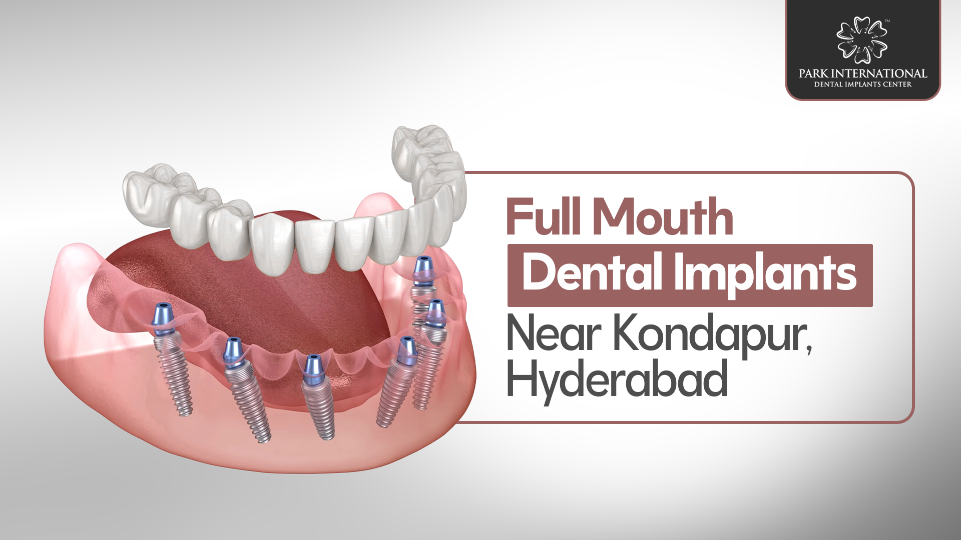 full mouth dental implants near Kondapur